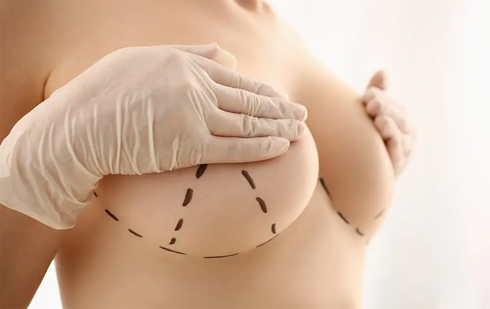 Chirurg mit Handschuhen an der Brust einer Patientin mit eingezeichneten Markierungslinien zur OP-Planung