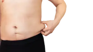 Lipödem Mann